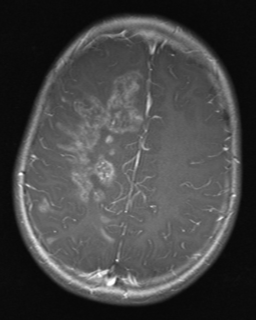 5A3 ADEM (Case 5) T1 POST Contrast 1 - Copy