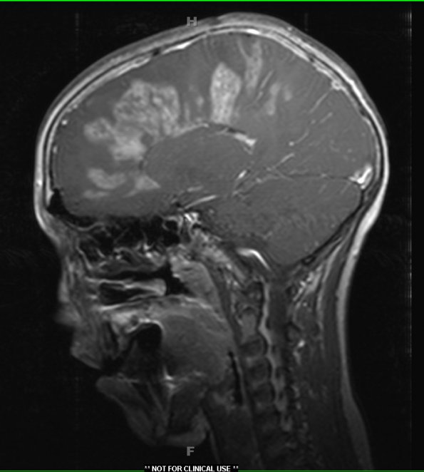 5A4 ADEM (Case 5) T1 POST Contrast 4 - Copy