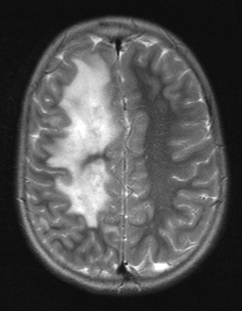 5A5 ADEM (Case 5) T2 without C 1 - Copy