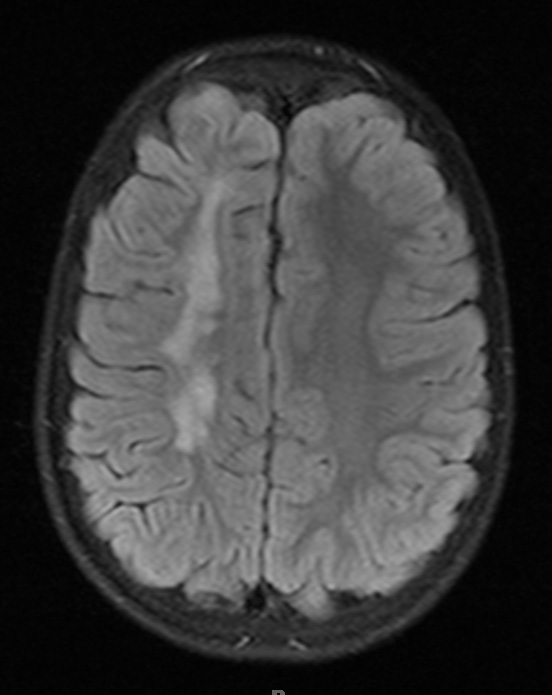 5B1 ADEM (Case 5) 1 year later FLAIR - Copy