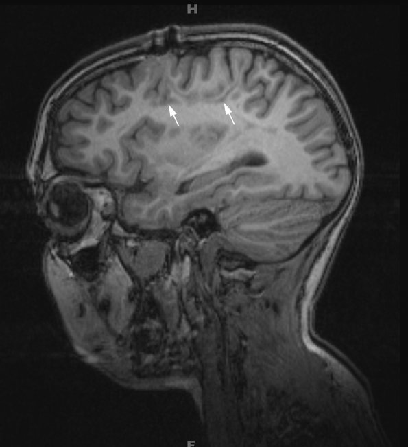 5B2 ADEM (Case 5) 1 year later T1 no contrast 1 - Copy copy