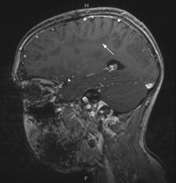 5B3 ADEM (Case 5) 1 year later GAD GRE 3D with contrast 2 - Copy copy