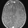 5B4 ADEM (Case 5) 1 year later MPR Range with contrast - Copy copy