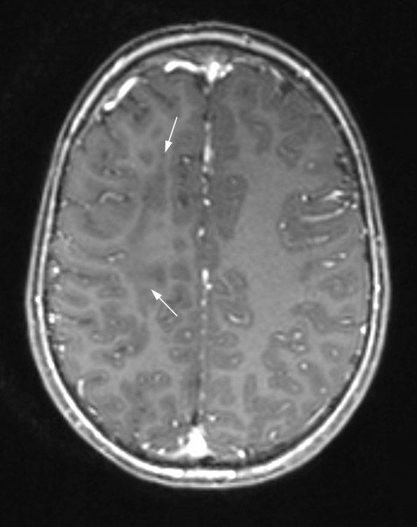 5B4 ADEM (Case 5) 1 year later MPR Range with contrast - Copy copy