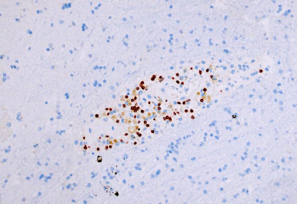 6E1 ADEM (Case 6) CD3 1