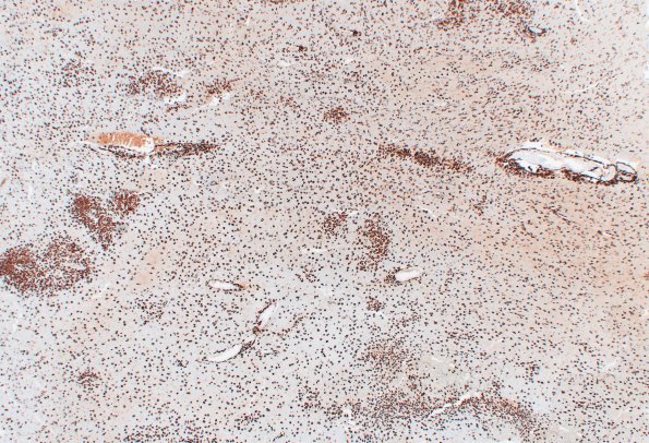 6H1 ADEM (Case 6) CD163 1