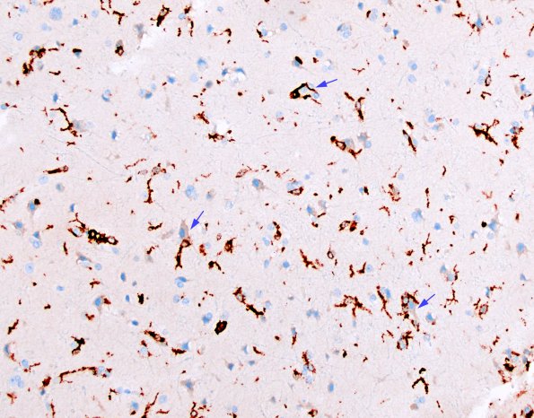 6H4 ADEM (Case 6) CD163 3A