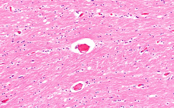 1A6 AHL (Case 1) R Parietal Semiovale H&E 20X