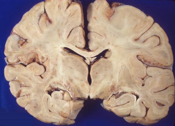 1B4 Acute Hemorrhagic Leukoencephalitis (AHL, Case 1) 1