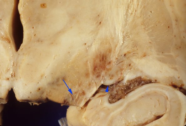 1B6 Acute Hemorrhagic Leukoencephalitis (AHL, Case 1) 3A copy