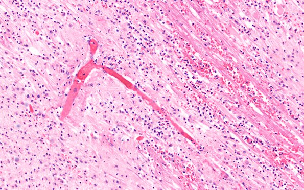 1C2 AHL (Case 1) BG H&E area B 20X