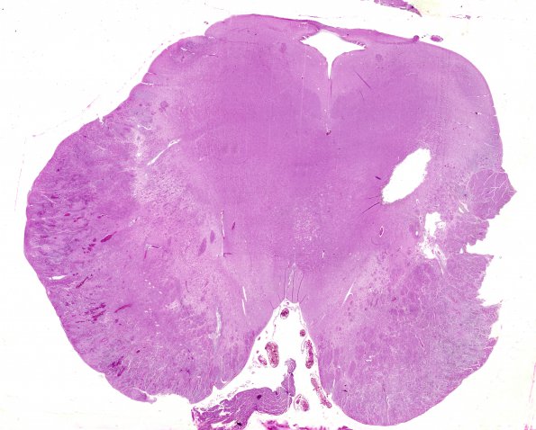 1E1 Acute Hemorrhagic Leukoencephalitis (AHL, Case 1) 3 H&E (midbrain)