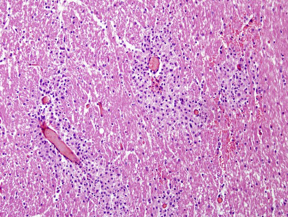 1E2 Acute Hemorrhagic Leukoencephalitis (AHL, Case 1) H&E 20X