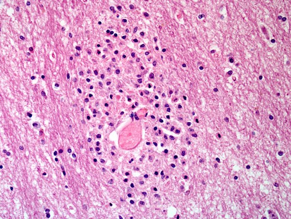 1E3 Acute Hemorrhagic Leukoencephalitis (AHL, Case 1) H&E 1