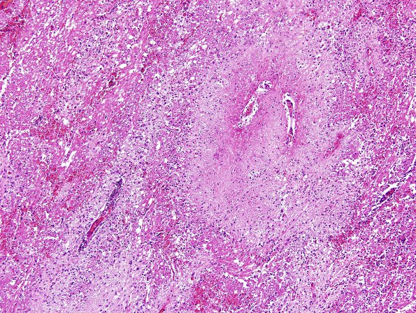 1E5 Acute Hemorrhagic Leukoencephalitis (AHL, Case 1) H&E 10X AB