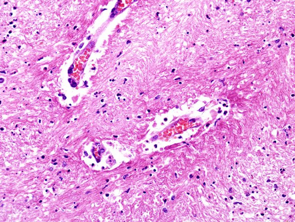 1E6 Acute Hemorrhagic Leukoencephalitis (AHL, Case 1) H&E 40X 2