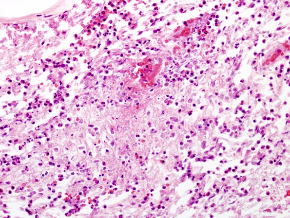 1E7 Acute Hemorrhagic Leukoencephalitis (Case 1) H&E 4