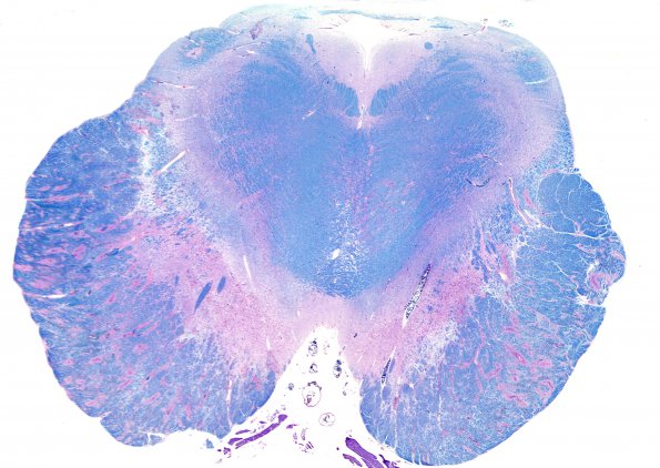 1F1 AHL (Case 1) 3 LFB-PAS whole mount (midbrain) 1