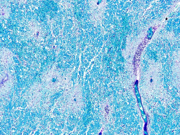 1F2 Acute Hemorrhagic Leukoencephalitis (AHL, Case 1) LFB-PAS 10X