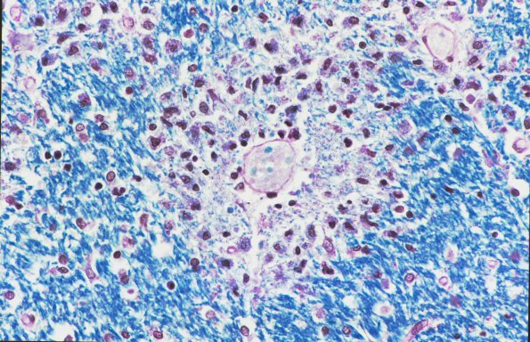 1F3 Acute Hemorrhagic Leukoencephalitis (AHL, Case 1) LFB-PAS 2 (compare w Biels 2)