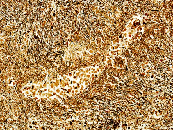 1G3 Acute Hemorrhagic Leukoencephalitis (AHL, Case 1) Biels 40X