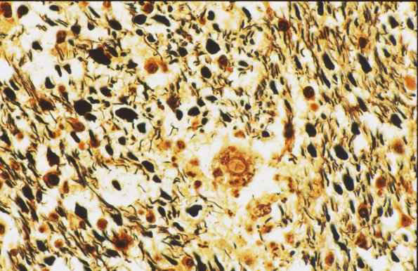 1G7 AHL (Case 1) Biels 2 (compare w LFB-PAS 2)