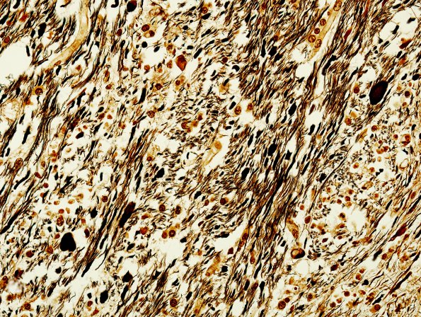 1G8 Acute Hemorrhagic Leukoencephalitis (AHL, Case 1) Biels 40X 1