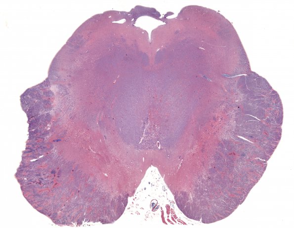 1H1 Acute Hemorrhagic Leukoencephalitis (AHL, Case 1) 3 PTAH whole mount (midbrain)