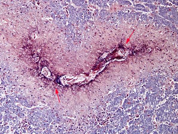 1H2 Acute Hemorrhagic Leukoencephalitis (AHL, Case 1) PTAH 1 copy