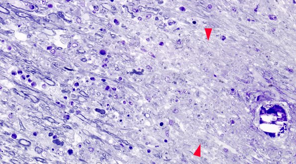 1J1 Acute Hemorrhagic Leukoencephalitis (AHL, Case 1) Plastic 2 copy