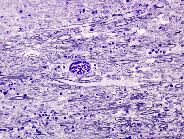 1J2 Acute Hemorrhagic Leukoencephalitis (AHL, Case 1) Plastic 3