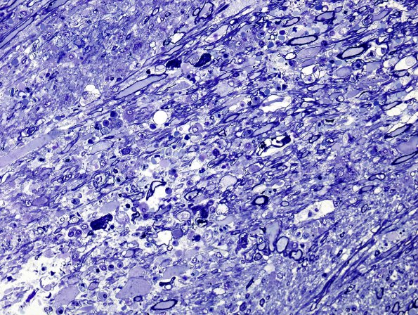 1J4 Acute Hemorrhagic Leukoencephalitis (AHL, Case 1) Plastic 9