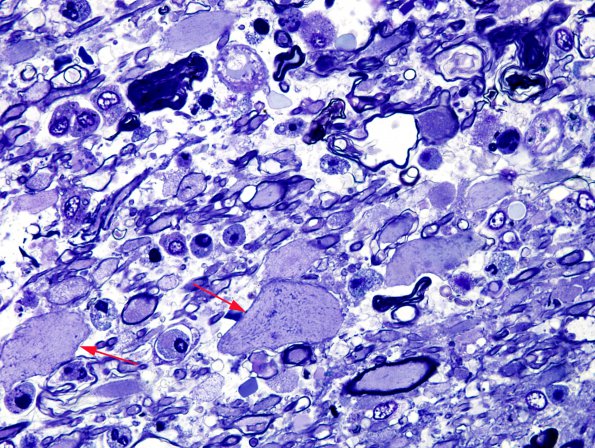 1J5 Acute Hemorrhagic Leukoencephalitis (AHL, Case 1) Plastic 8 copy