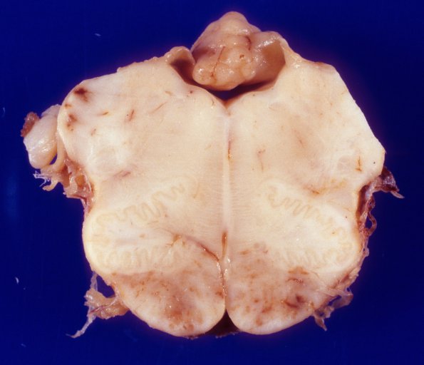 1K2 Acute Hemorrhagic Leukoencephalitis (AHL, Case 1) 8A