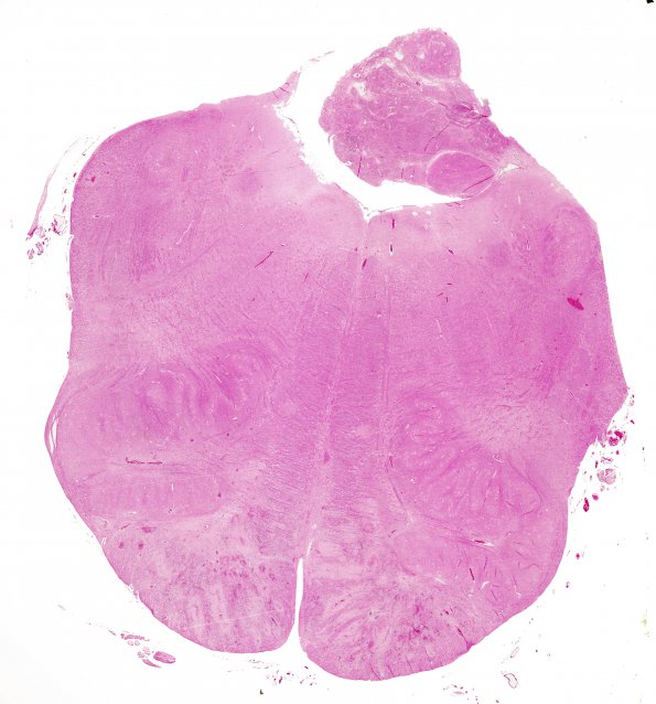 1L1 Acute Hemorrhagic Leukoencephalitis (AHL, Case 1) 8A H&E whole mount (medulla)