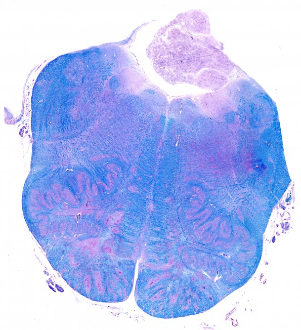 1L2 AHL (Case 1) 8B LFB-PAS whole mount (medulla)