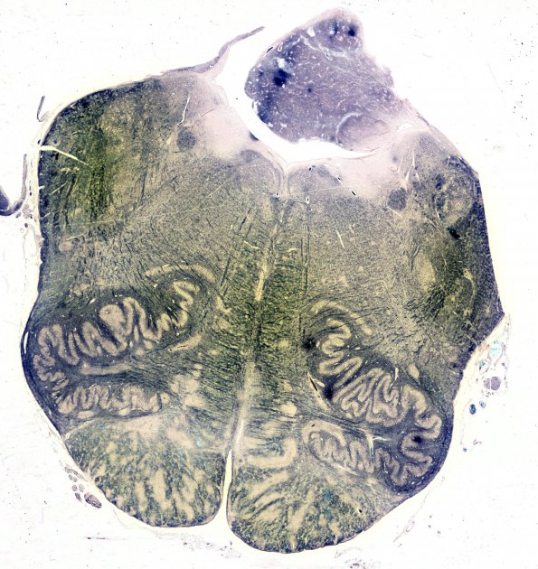 1L3 Acute Hemorrhagic Leukoencephalitis (AHL, Case 1) 8B Loyez