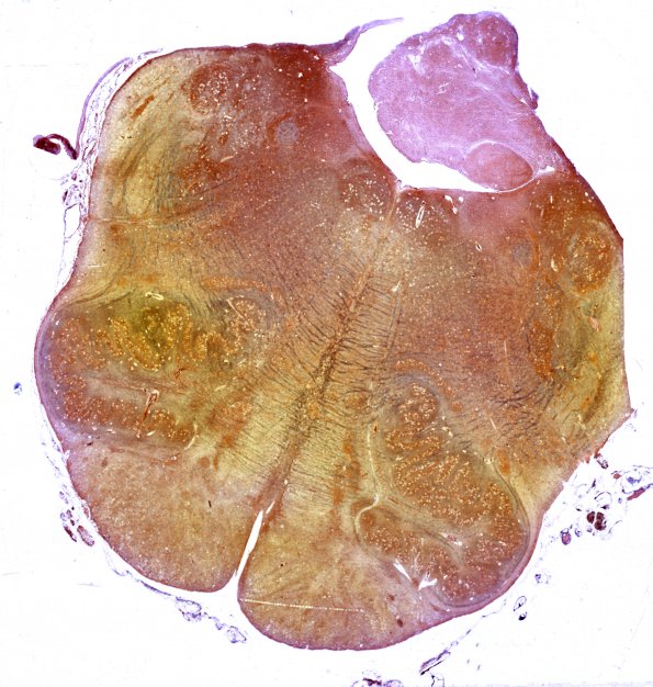 1L4 AHL, Case 1) 8B LFB-PAS whole mount (medulla) Bielschowsky