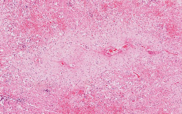 1L5A Acute Hemorrhagic Leukoencephalitis (AHL, Case 1) 8B H&E 10X area A