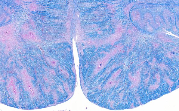 1L6 Acute Hemorrhagic Leukoencephalitis (AHL, Case 1) 8B LFB-PAS 2X