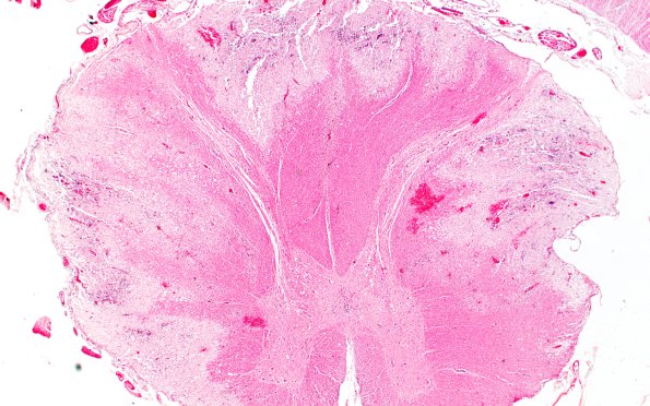 1M3 Acute Hemorrhagic Leukoencephalitis (AHL, Case 1) 1 H&E 2X flip-flop