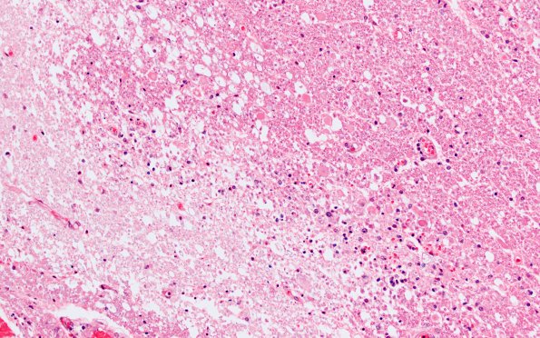 1M5 Acute Hemorrhagic Leukoencephalitis (AHL, Case 1) 1 H&E 20X area A