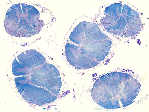 1N1 AHL (Case 1) 1 LFB-PAS whole mount (spinal cord)