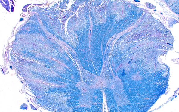 1N2 Acute Hemorrhagic Leukoencephalitis (AHL, Case 1) 1 LFB-PAS 2X