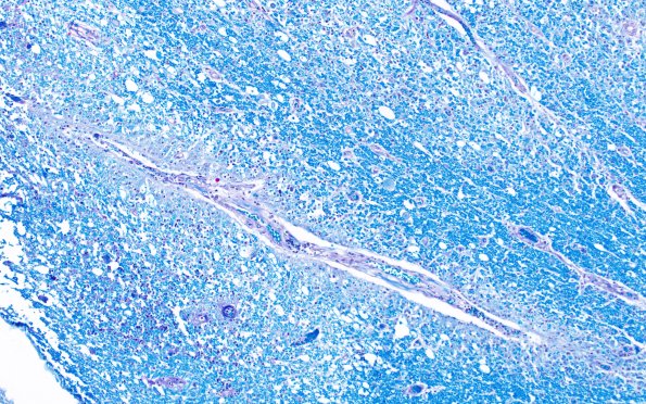 1N3 Acute Hemorrhagic Leukoencephalitis (AHL, Case 1) 4 LFB-PAS 20X area A