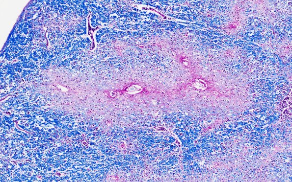 1N4 Acute Hemorrhagic Leukoencephalitis (AHL, Case 1) 8B LFB-PAS 10X area A