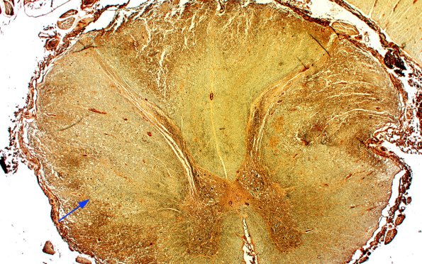 1O2 Acute Hemorrhagic Leukoencephalitis (AHL, Case 1) 1 Biels 2X copy