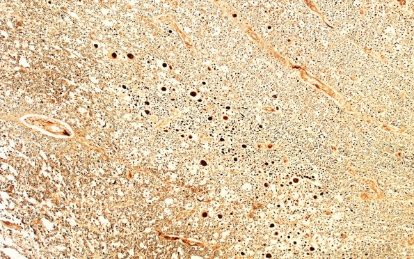 1O4 Acute Hemorrhagic Leukoencephalitis (AHL, Case 1) 1 Biels 20X area A 2