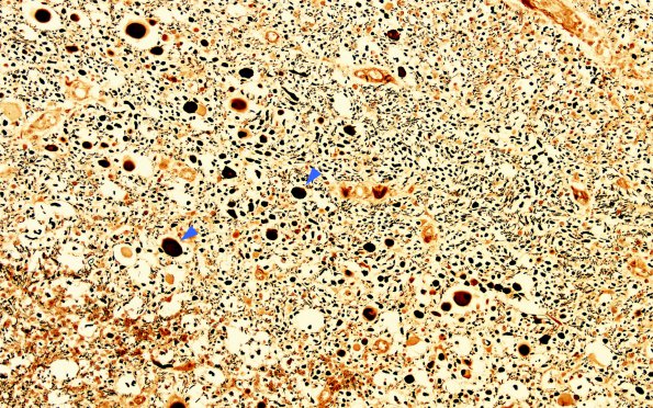 1O4 Acute Hemorrhagic Leukoencephalitis (AHL, Case 1) Biels spinal cord 20X copy