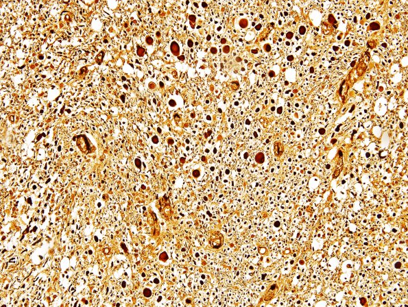 1O5 Acute Hemorrhagic Leukoencephalitis (AHL, Case 1) Biels (spinal cord)